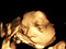 Baby 4D Ultraschall