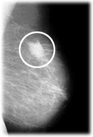 Das Bild zeigt einen krebsverdächtigen Knoten in der Brust.