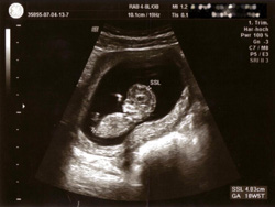 Ultraschall in der Schwangerschaftsbetreuung. Das Bild zeigt einen Fötus im Mutterleib.